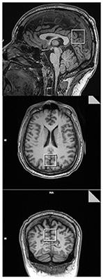 Case Report: Capacity to Objectively Monitor the Response of a Chronic Pain Patient to Treatment